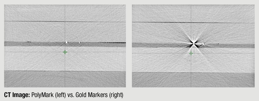 Polymark PM-1.0-3-18-20 – RT Cast Radiotherapy Solutions